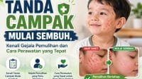 tanda campak mulai sembuh ruam mengering dan demam turun